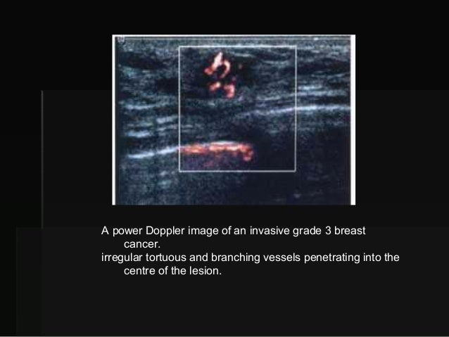 power doppler breast lesion Facial shyla stylez